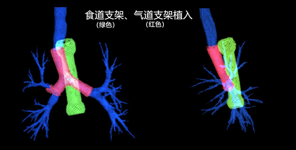 成功开展气管,食管双支架置入术 株洲市三三一医院介入治疗水平又增新