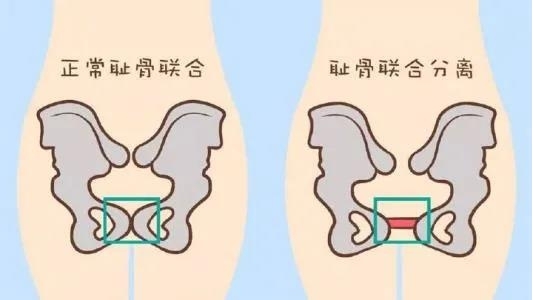 医卫 正文耻骨是靠耻骨韧带连接在一起的,所以叫"耻骨联合.