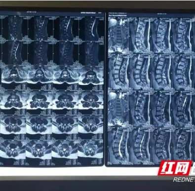 一个咳嗽险些直不起腰 寒冷天气腰突患者必须警惕