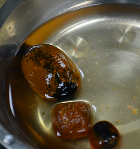 男子结石“潜伏”6年后爆发胆囊危机 手术取出时大如蛋