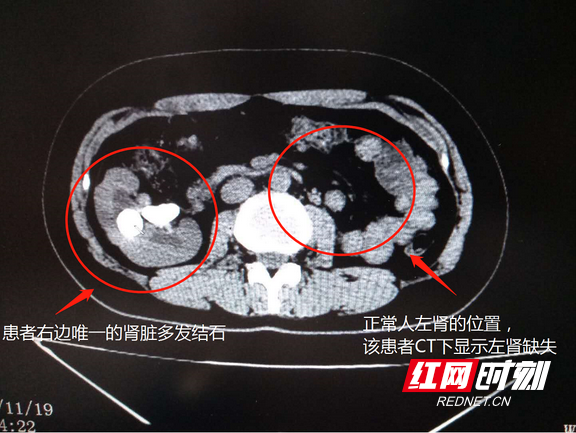 妙齡少女天生一個腎臟 不知結石填滿保命腎險致尿毒症