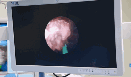 湘潭市中心医院泌尿外科引进全市首台硕通镜 碎石清石一步到位