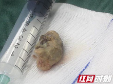 长沙52岁男子口腔恶臭遭家人嫌弃 原是体内长了这个