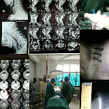 新化县顺利完成首台颈椎手术