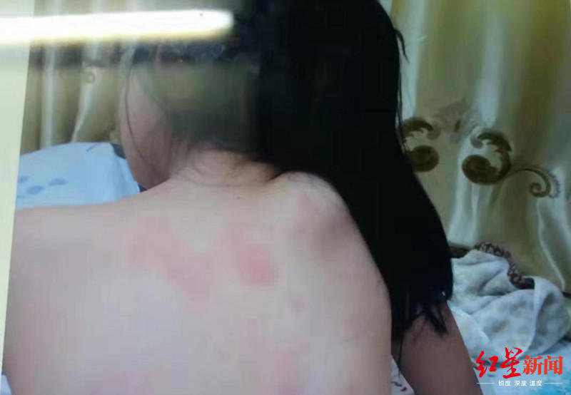 ↑被殴打后,高欣后背出现多处红肿