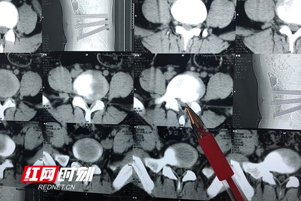 CT显示腰椎45椎间盘突出巨大.png