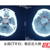 18岁女孩“近视加重”怪手机，原是脑袋里长鸡蛋大肿瘤