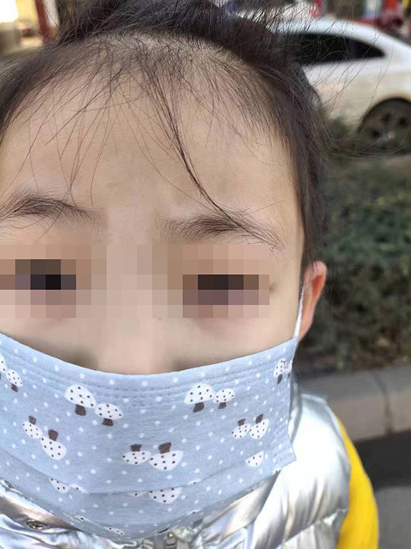 小花母亲说,女儿的左眼被塞了不止几十块小纸片。 小花母亲供图