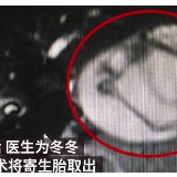 男婴腹中藏寄生胎：已发育9周肢体初见雏形