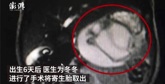 男婴腹中藏寄生胎：已发育9周肢体初见