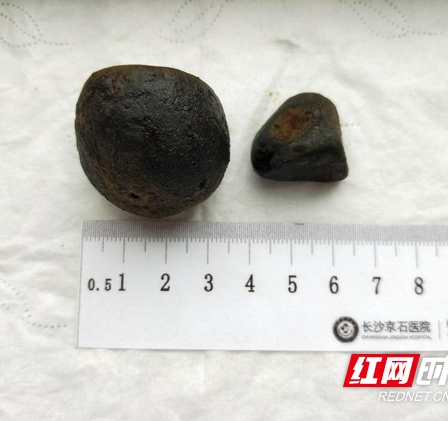 仅隔一个月 男子相继解决肾结石、胆结石难题