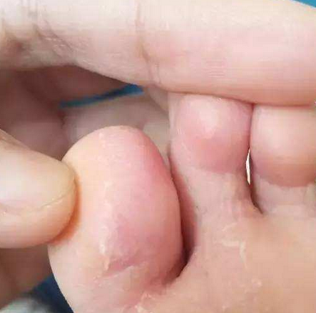 脚痒、脚臭、脚开裂？医生提醒你是患上脚气了