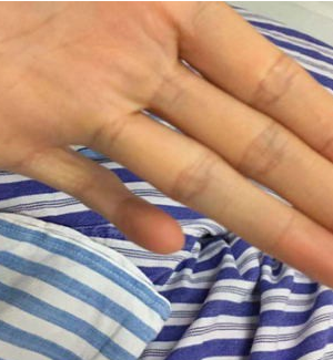 左小指屈曲畸形无法伸直 原来是术后疤痕挛缩引起
