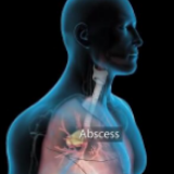 3D科普动画丨4分钟了解肺炎症状及危险因素
