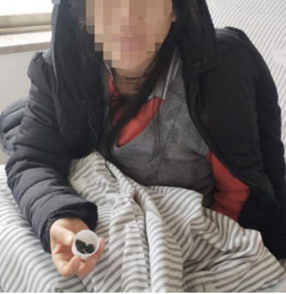 女子爱吃猪油患上胆结石 拒绝“一刀切”也能顺利保胆取石