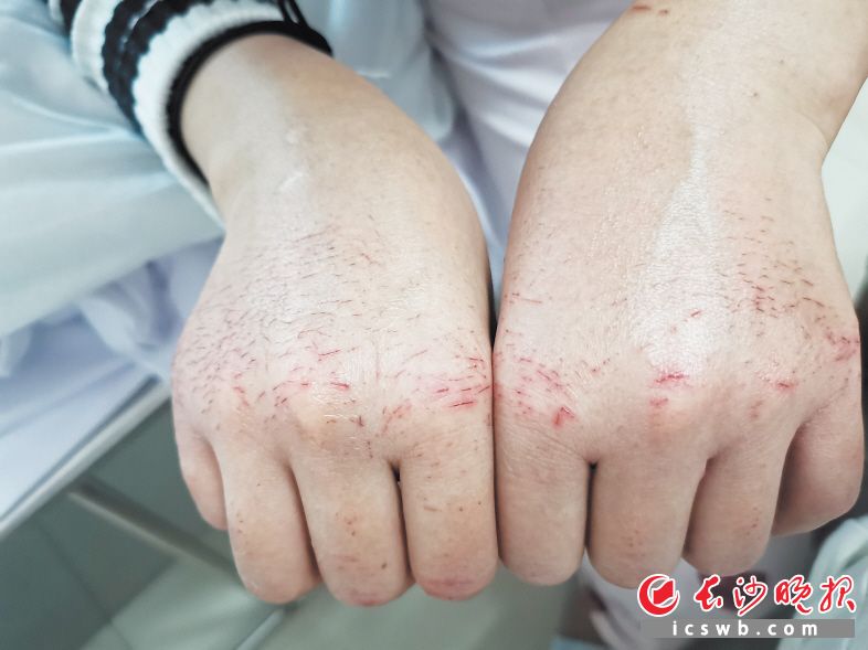 湖南省儿童医院感染科护士胡佩进入隔离病房4天后的一双手。 医院供图