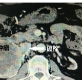 二次肾移植术后患者反复发热 罪魁祸首原来是“它”