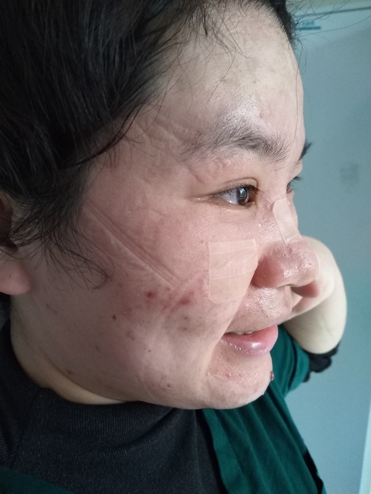 摘下防护面罩，护士脸上留下深深印痕。市一医院 供图