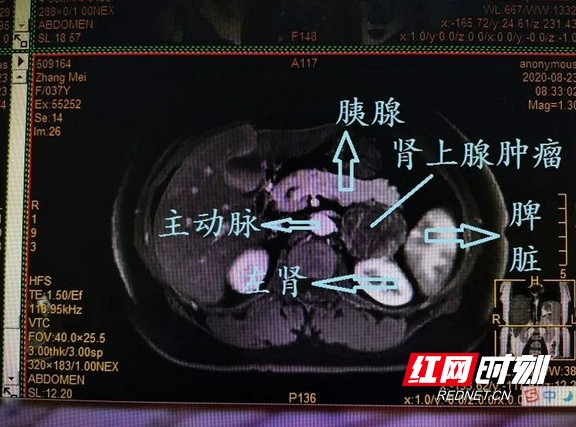 急性肠胃炎b超图片