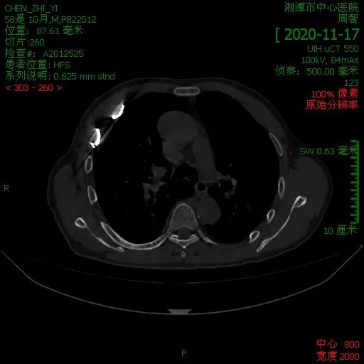 心胸外科完成湘潭市首例胸腔鏡肋骨骨折內固定術