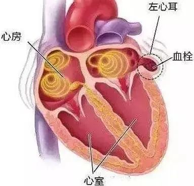 湘潭市中心醫院心血管內科成功獨立完成一例左心耳封堵術