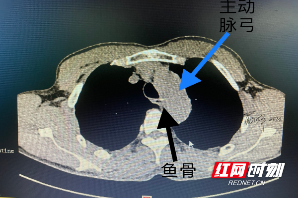 术前CT显示：鱼刺紧邻主动脉弓。 (2).jpg