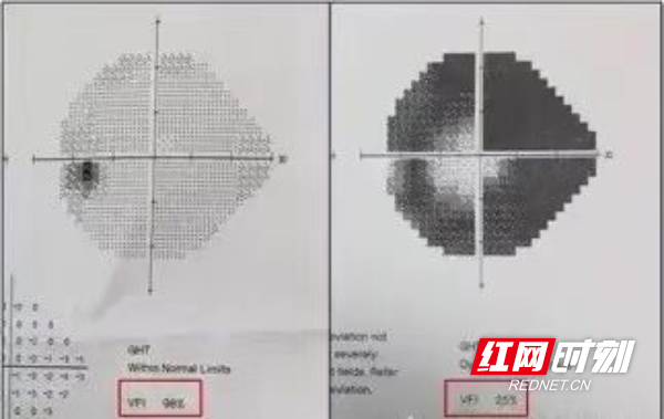 别让青光眼偷走你的视力1 (3).jpg