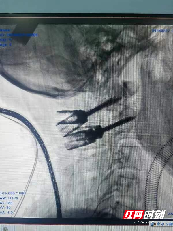 男子车祸遭遇颈椎骨折，医务人员挑战高难度手术成功救治1 (2).jpg