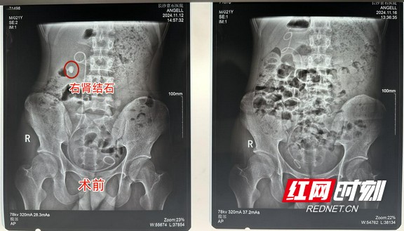 小伙患结石多年仅靠输液止痛 腰痛就医发现尿源性脓毒血症