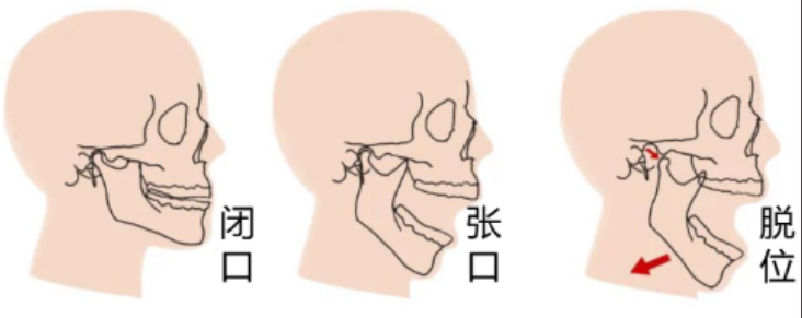 颞下颌关节脱位示意图。通讯员供图